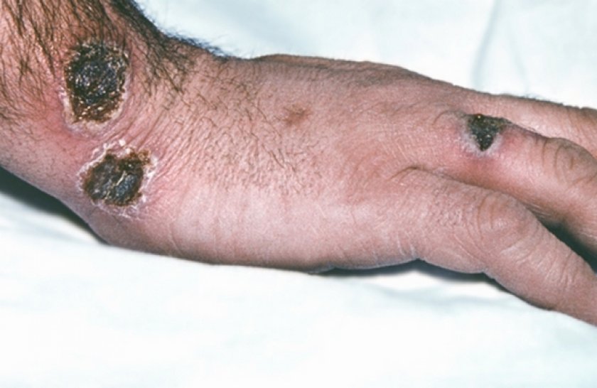 Сибирская язва