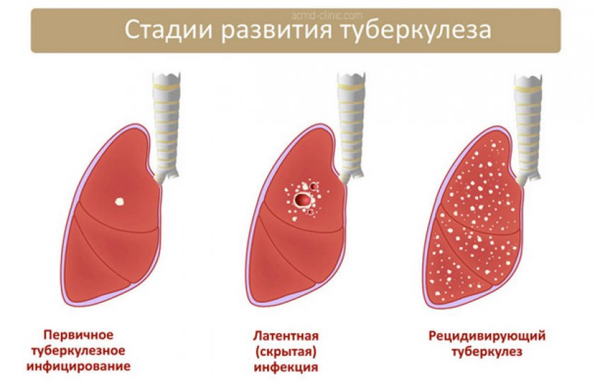 Туберкулез