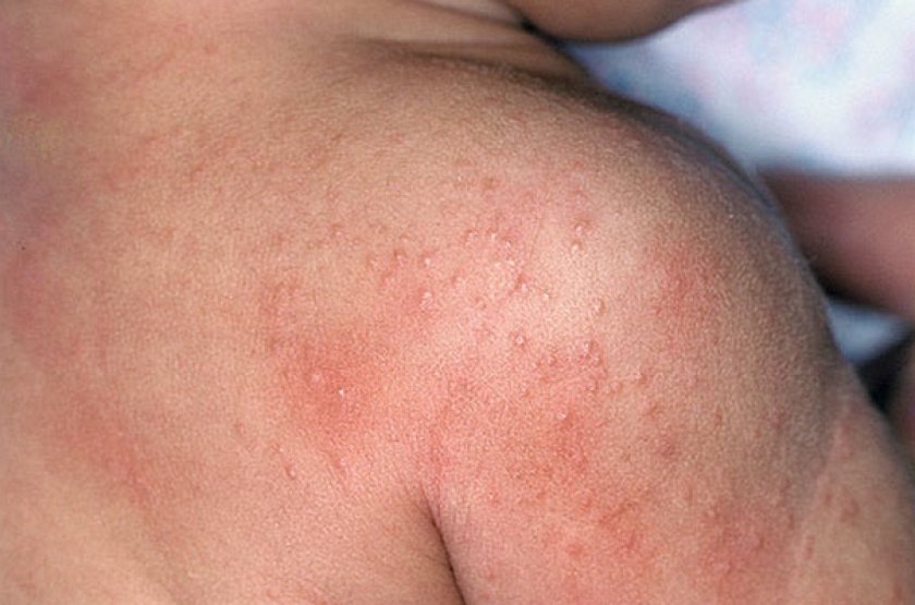 Псевдотуберкулез