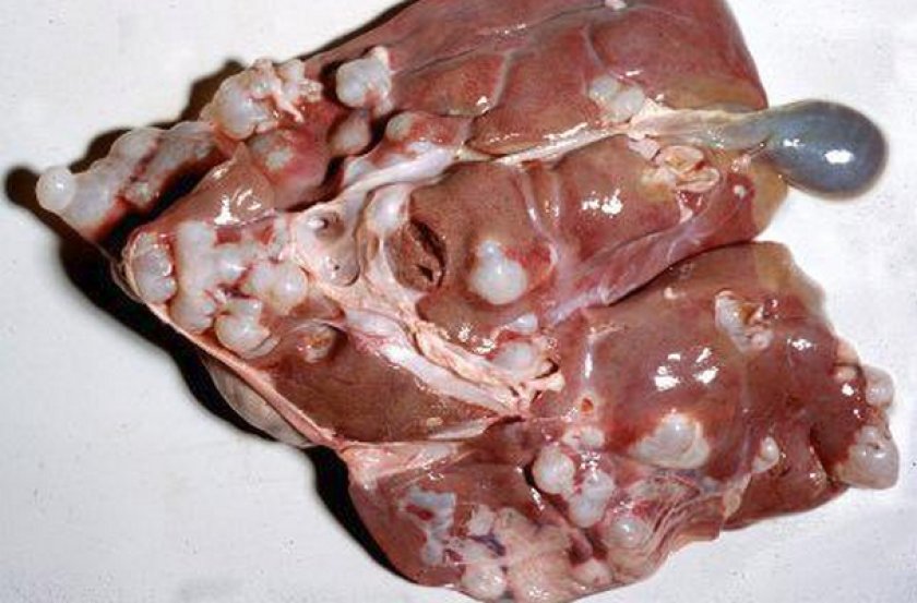 Эхинококкоз