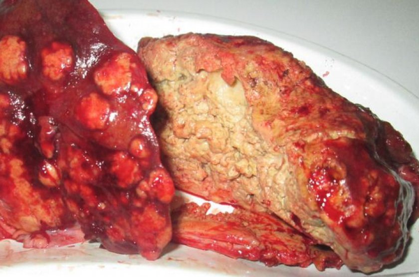 Альвеококкоз