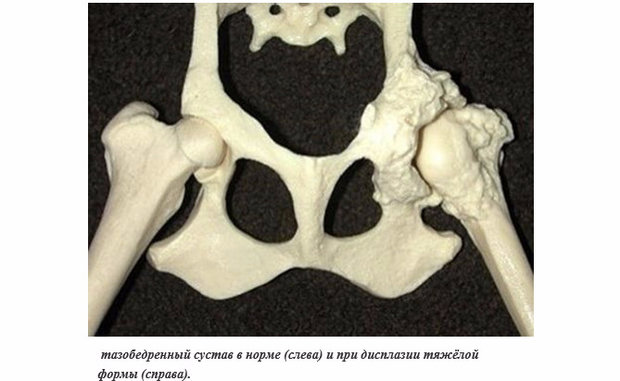 Дисплазия тазобедренного сустава Дисплазия тазобедренного сустава