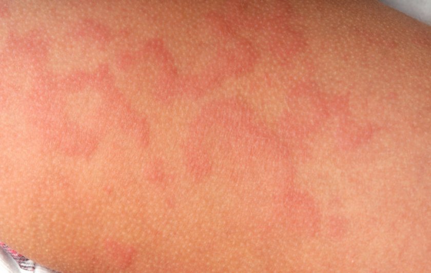 Анафилаксия Анафилаксия