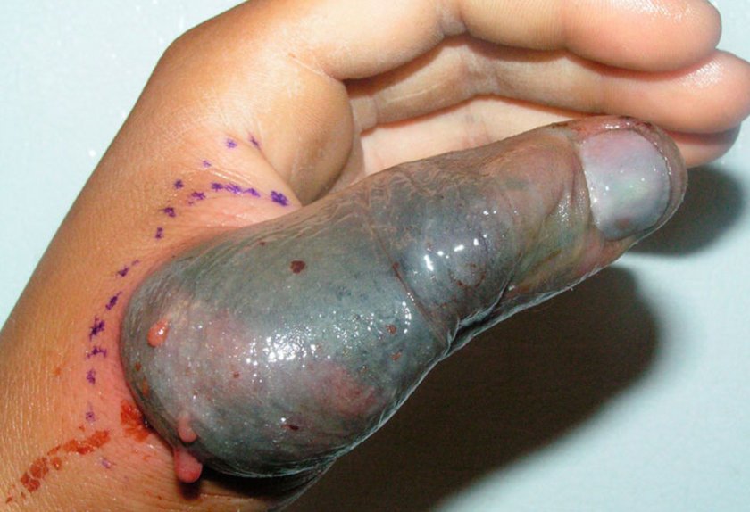 Укус шпильковой змеи