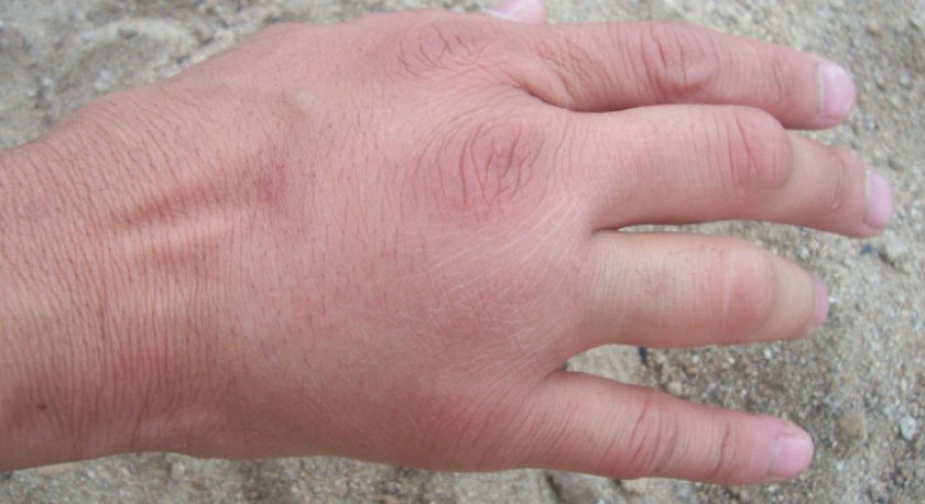 Укус гадюки