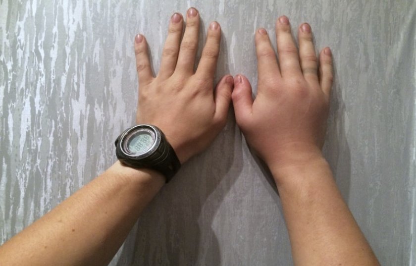 Укус гадюки