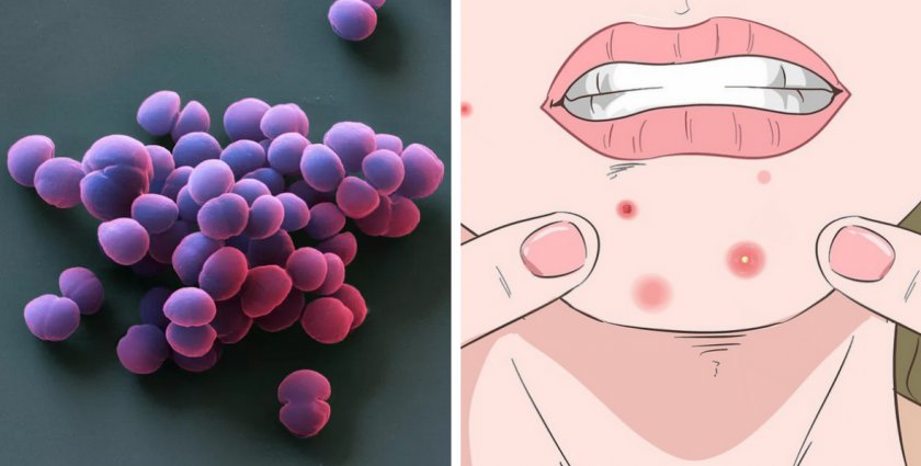 Заражение стафилококком