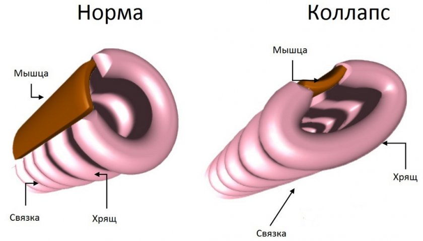 Коллапс трахеи у собаки Коллапс трахеи у собаки