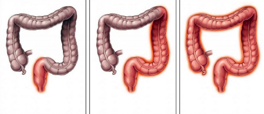 Хронический колит