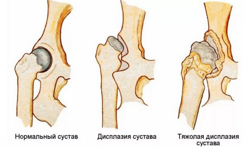 Дисплазия тазобедренного сустава Дисплазия тазобедренного сустава