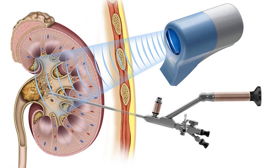 Ультразвуковое удаление камней у собаки