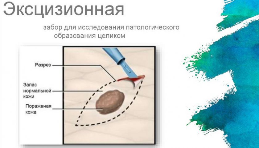 Эксцизионная бипсия Эксцизионная бипсия