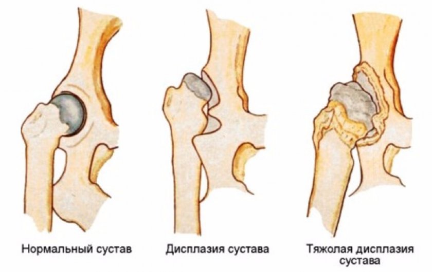 Дисплазия тазобедренного сустава Дисплазия тазобедренного сустава