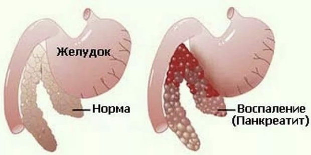 Панкреатит Панкреатит